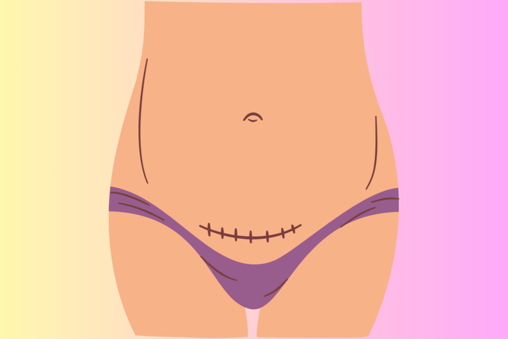 Recuperação da cesárea